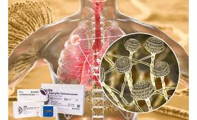 Aspergillosis fungal infections can occur in the ear canal, eyes, nose, sinus. Invasive Aspergillosis Screening In Covid 19 Critical Care