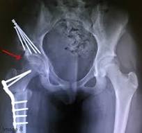 Osteotomía periacetabular (OPA) - Stanford Medicine ...