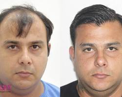 Image of person with successful hair transplant results