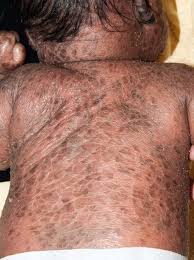 Image result for Ichthyosis