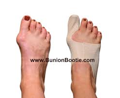 This corrector comfortably bends in the bone and toe, as well. Bunion Bootie Natural Non Surgical Bunion Treatments