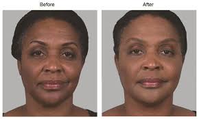 Use at the site of skin sores, … Sculptra Los Angeles Wrinkle Treatment Santa Monica