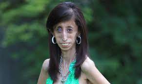 Maybe you would like to learn more about one of these? Cum A Ajuns SÄƒ Arate Acum Cea Mai UratÄƒ Femeie Din Lume Lizzie Velasquez E De Nerecunoscut Impact