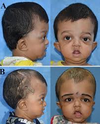 Robot-assisted frontofacial correction in very young children with  craniofacial dysostosis syndromes: a technical note and early functional  outcome in: Neurosurgical Focus Volume 52 Issue 1 (2022) Journals