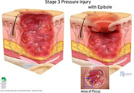 Pressure Ulcer Prevention And Treatment Assessment Wound Care And Healing