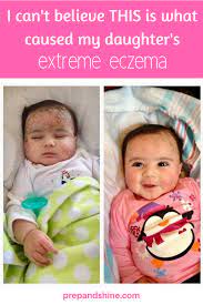 Food Allergies Eczema The Journey Of How I Learned By Child Was Allergic To 8 Foods Read Thi Baby Eczema Treatment Baby Eczema Remedies Baby Food Allergies