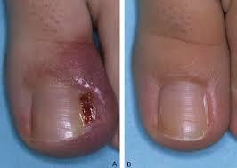 Image result for Toenail Removal