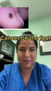 Understanding Foot Cancer: Symptoms, Treatment, and Biopsy