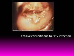 Image result for Acute Cervicitis