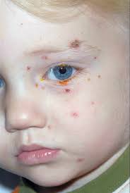 Image result for yellow scabs on the face in children