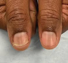 Image result for Pitting nails feet