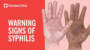 Image result for syphilis symptoms
