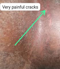 Image result for sore skin in the groin area