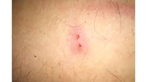 Image result for bedbug bites look like