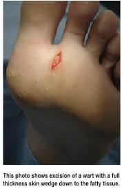 Means for removing warts usa. Current Concepts In Managing Plantar Warts Podiatry Today