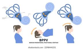 Image result for Canalith Repositioning Procedure