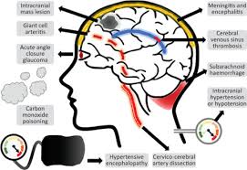 Image result for Acute Localized Headache