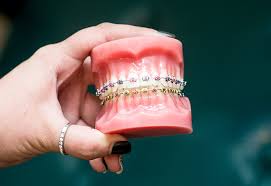 Patients can typically continue to enjoy the foods they normally eat. Braces Colorado Springs Johnson Orthodontics