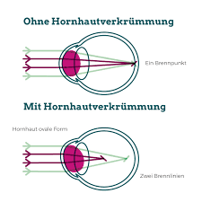 Stabsichtigkeit wird die hornhautverkrümmung auch genannt. Welche Kontaktlinsen Arten Gibt Es Lensvision Kontaktlinsen