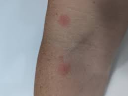 Image result for mite bites on humans