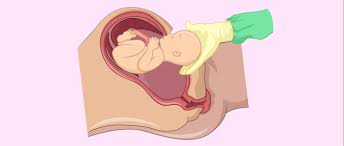 Analgesia epidural en el parto: El Parto Preparacion Tipos Y Posibles Complicaciones