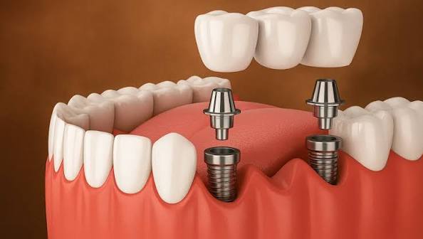 100% Best Dental Implants in Chennai | Denticare Clinic