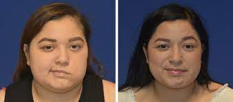 With or without treatment, most individuals begin to get better within 2 weeks after the initial onset of symptoms and recover completely within 3 to 6 months. Bell S Palsy Facial Paralysis Treatment Los Angeles California