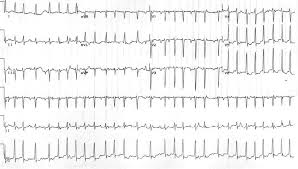 Supraventricular tachycardia (svt), also known as paroxysmal supraventricular tachycardia, occurs when electrical impulses above the heart's ventricles (supraventricular). Svt Behandlung Paroxysmale Supraventrikulare Tachykardiebehandlung Ii Klinische Und Elektrophysiologische Arten Der Svt