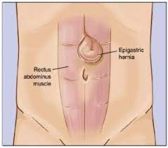 An epigastric hernia happens in the you may be given contrast liquid to help the organs show up better in the pictures. Epigastric Hernia Torrance Hernia Center