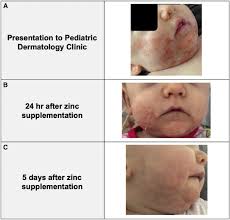 Image result for Zinc Deficiency