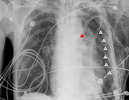 Image result for Intrapleural Anesthesia