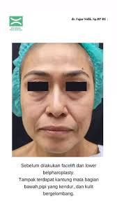 ✨ Facelift & Lower Blepharoplasty ✨, Pasien usia 49 tahun telah dilakukan  facelift 8 bulan yang lalu., Tampak wajah kembali kencang namun tetap  terlihat natural., #facelift, #faceliftjakarta, ...