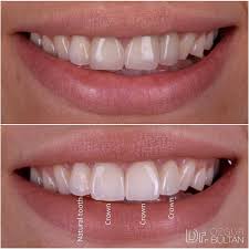 Grayish Zirconia Crowns Were Replaced With Ips E Max Restorations I Would Like To Place Non Prep Veneers On Canines Too Bu Dental Dentistry Cosmetic Dentistry