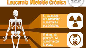 Le leucemie croniche sono caratterizzate dall'accumulo nel sangue, nel midollo osseo, nella milza e spesso nei linfonodi di globuli bianchi che maturano in modo quasi normale. Leucemia Mieloide Cronica Nuevas Drogas Pueden Lograr Que El Paciente Ya No Se Medique En 2 Anos Infobae