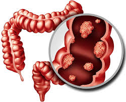 In the united states, one in 20 people is here in this article, we are going to know the signs and symptoms of this colon cancer and how to overcome this problem with an early treatment to get faster recovery. Colon Cancer Orange County Hemorrhoid Clinic