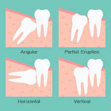 Maybe you would like to learn more about one of these? Wisdom Teeth Removal Costs Information Dental Guide Australia
