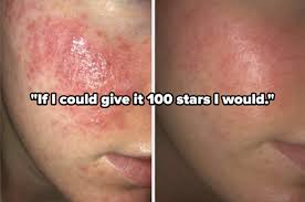Check spelling or type a new query. 15 Products For Cystic Acne Our Readers Actually Swear By