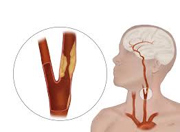 There are 2 common carotid arteries: Carotid Artery Disease Johns Hopkins Medicine