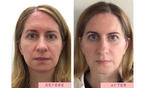 Before And After Face Yoga