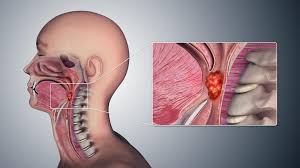 The growth may have the appearance of a wart, crusty spot, ulcer, mole or sore. Throat Cancer Symptoms Pictures Causes And Treatment