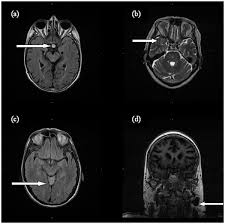 Image result for Incidental Imaging Finding