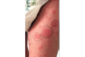 Chilblains causes the skin on your toes. Covid Toes Rashes How The Coronavirus Can Affect Your Skin