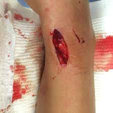 After removing the stitches, it is vital to clean the wound area once more with an antiseptic wipe. Do You Need To Get Stitches For That