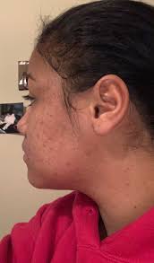 This is my 16 year old daughter. She has been using the 3 in 1 cleansing  bar for 5 consecutive weeks to clear her acne. Look at her progress!!! 🚨  🚨 🚨