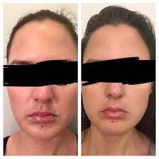 Update after juvederm! See comments : r/30PlusSkinCare