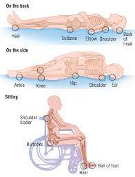 Bedsores Also Called Pressure Ulcers Or Decubitus Ulcers Are Areas Of Broken Skin That Can Develop In People Who Wound Care Nursing Wound Care Pressure Ulcer