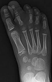 Most injuries are the consequence of acute trauma during sports. The Foot And Ankle Congenital And Developmental Conditions Radiology Key