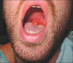 Image result for Uvulitis