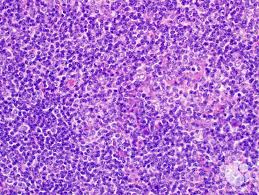 Nodular Lymphocyte Predominant Hodgkin Lymphoma 4