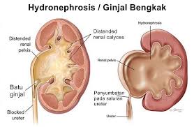 Ayo Ketahui Apa Saja Yang Menjadi Penyebab Ginjal Bengkak Dan Juga Faktor Risikonya Untuk Melakukan Pencegahan Sedini Mungkin Ginjalbengkak Penyebabginjalbe